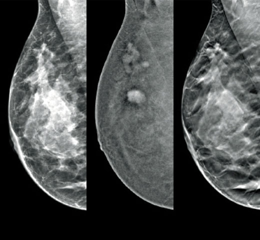 Técnica de imagen con contraste I-View™ de Hologic