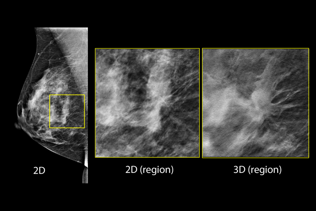 Imágenes clínicas de una mamografía con una lesión sospechosa