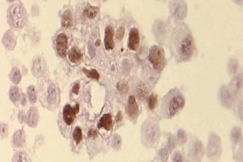 Tumor de Wilms 1