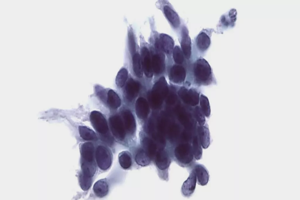 Imagen de citología cervicovaginal convencional de neoplasia intraepitelial cervical glandular