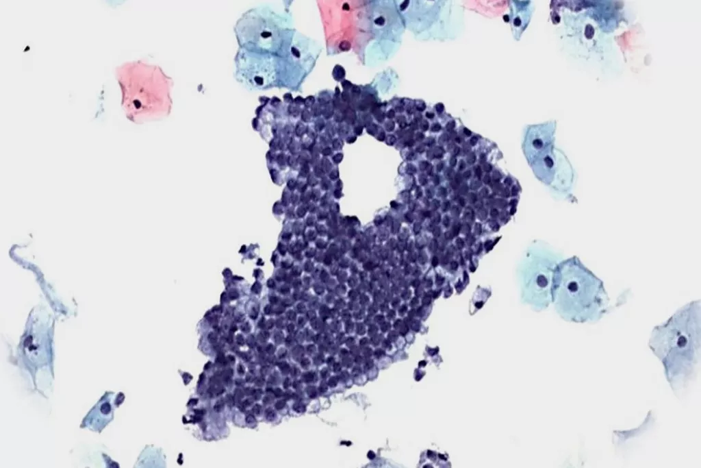 Imagen de citología cervicovaginal convencional negativa con células endocervicales