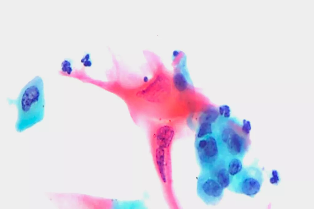 carcinoma escamoso, orina, tinción de Papanicolaou