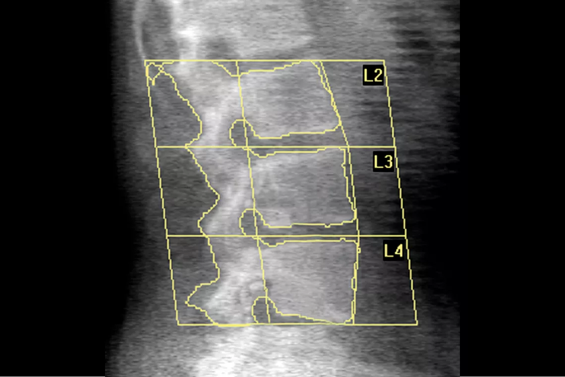 Radiografía de la columna vertebral