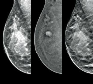 Técnica de imagen con contraste I-View™ de Hologic