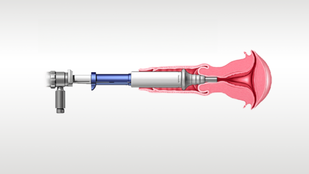 Ilustración de un instrumento médico en uso.